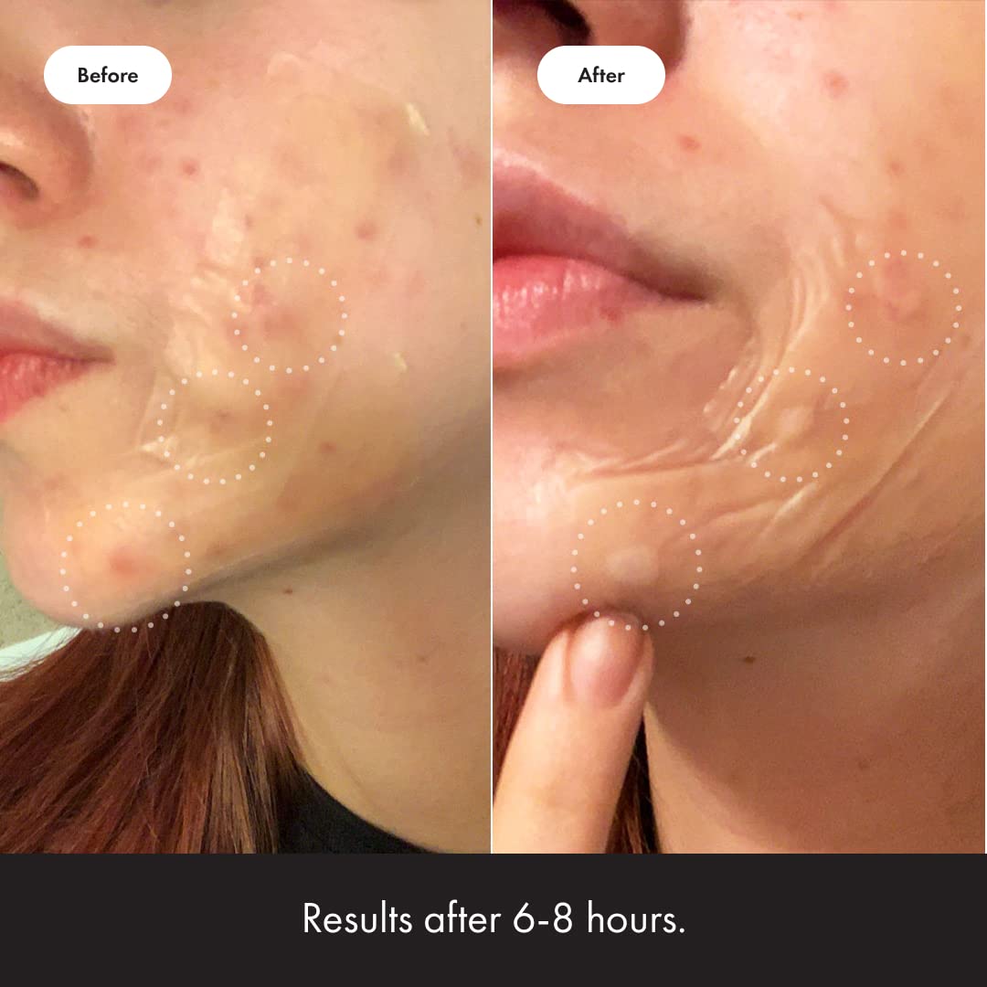 Hero Cosmetics - Mighty Patch Surface - 10 Strip(s) - The Oasis of Health